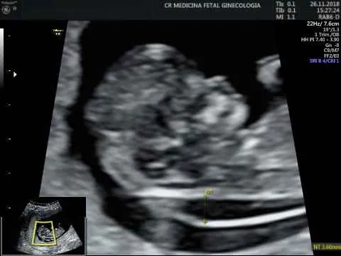 A Transluscência nucal do meu bebê está aumentada!! E agora?