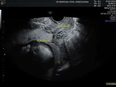 Placenta baixa! O que preciso saber?