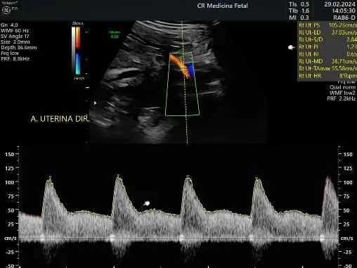 Artéria uterina com incisura ao Doppler. Tenho que me preocupar?